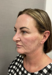 Spring Thread® is a cutting-edge, permanent thread lift developed in France. This innovative treatment uses specially designed biocompatible threads to lift and reposition sagging skin. Therefore offering a more youthful appearance. The threads are made from silicone and polyester—materials known for their safety and compatibility with body tissues.