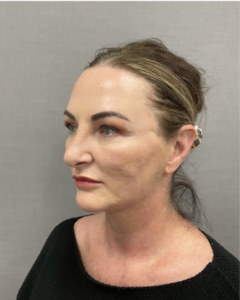Spring Thread® is a cutting-edge, permanent thread lift developed in France. This innovative treatment uses specially designed biocompatible threads to lift and reposition sagging skin. Therefore offering a more youthful appearance. The threads are made from silicone and polyester—materials known for their safety and compatibility with body tissues.