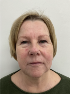 Spring Thread® is a cutting-edge, permanent thread lift developed in France. This innovative treatment uses specially designed biocompatible threads to lift and reposition sagging skin. Therefore offering a more youthful appearance. The threads are made from silicone and polyester—materials known for their safety and compatibility with body tissues.