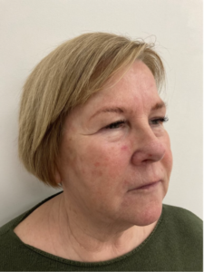 Spring Thread® is a cutting-edge, permanent thread lift developed in France. This innovative treatment uses specially designed biocompatible threads to lift and reposition sagging skin. Therefore offering a more youthful appearance. The threads are made from silicone and polyester—materials known for their safety and compatibility with body tissues.