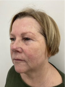 Spring Thread® is a cutting-edge, permanent thread lift developed in France. This innovative treatment uses specially designed biocompatible threads to lift and reposition sagging skin. Therefore offering a more youthful appearance. The threads are made from silicone and polyester—materials known for their safety and compatibility with body tissues.