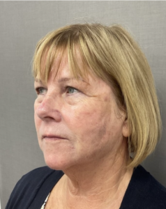 Spring Thread® is a cutting-edge, permanent thread lift developed in France. This innovative treatment uses specially designed biocompatible threads to lift and reposition sagging skin. Therefore offering a more youthful appearance. The threads are made from silicone and polyester—materials known for their safety and compatibility with body tissues.