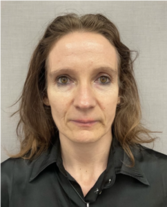 Sculptra offers a powerful solution by working with your body’s natural collagen production. Unlike traditional fillers that provide instant volume, Sculptra injections gradually rebuild your skin’s structure from within, delivering subtle, natural-looking results that improve over time.