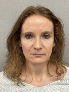 Sculptra offers a powerful solution by working with your body’s natural collagen production. Unlike traditional fillers that provide instant volume, Sculptra injections gradually rebuild your skin’s structure from within, delivering subtle, natural-looking results that improve over time.