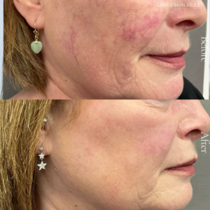 As we age our skin becomes more susceptible to damage due to hereditary conditions, sun and environmental exposure, and the natural ageing process. These factors result in an uneven skin tone, broken veins, and brown patches, dark freckles or sun spots. To target these concerns we use a photo rejuvenation system that combines IPL (intense pulsed light) and radio frequency to allow us to effectively fade and reduce the appearance of these skin imperfections.
