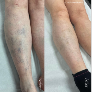 Sclerotherapy and Thermolysis are two clinically proven, highly effective treatment options. Similarly can be used for getting rid of unsightly spider veins, thread veins, blood spots and broken capillaries.