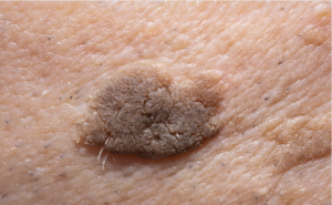 Keratosis removal in Bexleyheath, Kent
