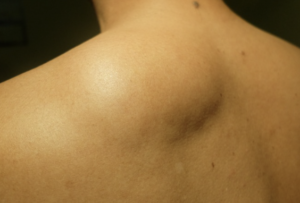 surgical removal of Lipomas at Persona Medical Aesthetics Bexleyheath Kent