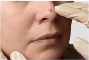 A Mole, or naevus, is a normal skin growth that develops when pigment-producing cells (melanocytes) grow in groups. Moles can appear in a range of different colours, shapes and sizes.