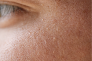 Syringomas are small, firm, benign bumps that form when sweat glands become overactive. They are skin-coloured, yellowish, brown, or pink, and are usually 1–3 millimeters wide. They often appear in clusters on both sides of the body.