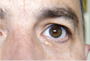 Xanthelasma treatment in the Bexleyheath, Kent area.