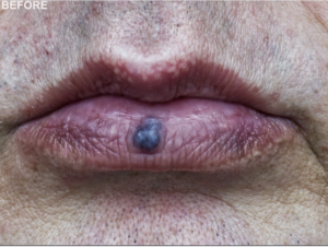 Venous lakes are a type of venous malformation that forms a blue spot, most typically on the lower lip. It is a made up of dialated abnormal veins, usually appearing as soft, compressible, dark blue spot in the lower lip. No one knows what causes venous lakes to form but sun and UV damage are thought to play a role. They are most often seen in people older than 50 and are more common in men than in women.