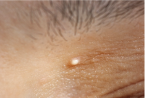 Milia (or milium) are tiny white bumps near the surface of your skin. Anyone can get them at any time of life. You can find them anywhere on the body, but they often cluster around the eyes, nose, cheeks and forehead.