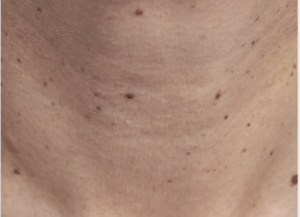 We are experts on all-things skin – including minor skin surgery. ‘Surgery’ can be an intimidating word, but rest assured, removing common lumps, bumps and blemishes are very straight forward simple procedures for us to perform and we have a lot of experience doing this. All treatments are carried out under local anaesthetic after which you can carry on life as normal, minus your troublesome friend.