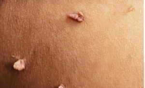 Skin Tag removal in Bexleyheath, Kent