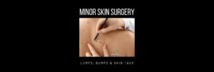 We are experts on all-things skin – including minor skin surgery. ‘Surgery’ can be an intimidating word, but rest assured, removing common lumps, bumps and blemishes are very straight forward simple procedures for us to perform and we have a lot of experience doing this. All treatments are carried out under local anaesthetic after which you can carry on life as normal, minus your troublesome friend.