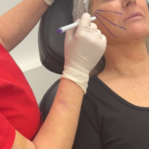 Spring Thread lift trending treatments at Persona Medical Aesthetics Bexleyheath