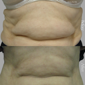 fat dissolving injections in Bexleyheath, Kent