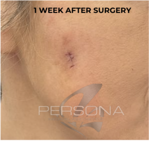 1 week after cyst removal treatment, Bexleyheath, Kent.