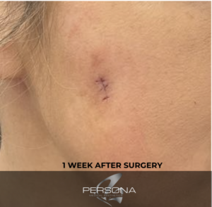Cyst removal after 1 week post treatment
