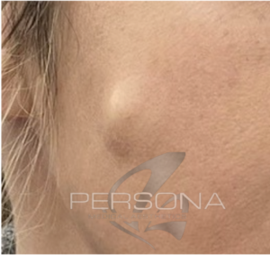Before cyst removal treatment at Persona Medical Aesthetics in Bexleyheath, Kent.