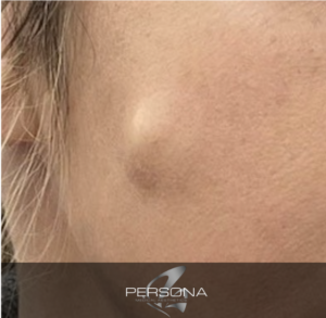 Cysts are slow growing, benign bumps which grow under the skin and can occur almost anywhere on the body. Although not life threatening, cysts can often be a cause of discomfort or embarrassment for people with visible facial cyst or skin cyst or arm cyst.