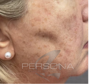 Keratosis removal skin surgery treatment at Persona Medical Aesthetics in Bexleyheath Kent.