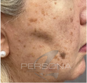 Keratosis removal skin surgery treatment at Persona Medical Aesthetics in Bexleyheath Kent.
