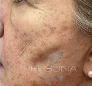 Keratosis removal skin surgery treatment at Persona Medical Aesthetics in Bexleyheath Kent.