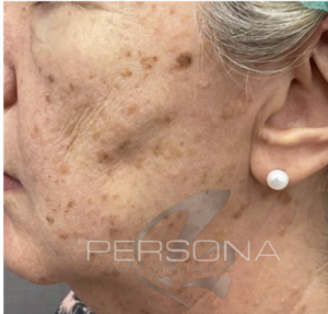 Keratosis skin concern