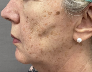 A keratosis is a common benign skin growth, similar to a mole. Most people will have at least one in their lifetime. They tend to appear in mid-adulthood and their frequency increases with age. They are harmless .