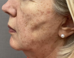 A keratosis is a common benign skin growth, similar to a mole. Most people will have at least one in their lifetime. They tend to appear in mid-adulthood and their frequency increases with age. They are harmless .
