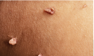 Skin tags (acrochordons) are small, noncancerous growths that tend to be the same colour as your skin. They often look like a cluster of skin tissue extending out from a tiny stem. They’re sometimes darker and may resemble a raised mole. Most skin tags are between 1-5 mm, but some can grow as large as a few centimetres. Skin tags do not affect your health. But they can be unsightly. If they are in areas like your face and neck, they can make you self-conscious. A skin tag removal procedure can help.