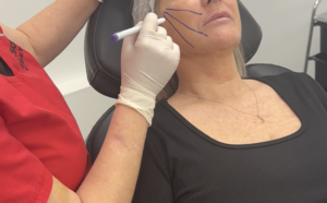 Spring Thread Lift is a revolutionary facial lifting technique that provides a durable, natural-looking lift without the need for invasive surgery.