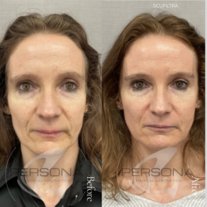 Sculptra collagen stimulator treatment at Persona Medical Aesthetics Bexleyheath, Kent.