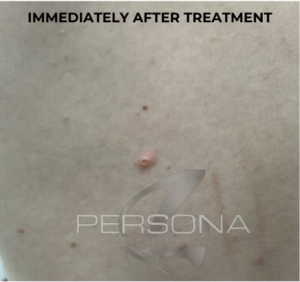 Skin tag straight after removal treatment.