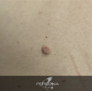 Skin tag are small, noncancerous growths that tend to be the same colour as your skin. They often look like a cluster of skin tissue extending out from a tiny stem. They’re sometimes darker and may resemble a raised mole. Most skin tags are between 1-5 mm, but some can grow as large as a few centimetres. Skin tags do not affect your health.