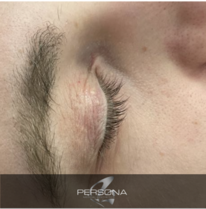 Xanthelasma is a skin condition in which flat, yellow growths develop under the skin. If it occurs on the eyelids, it is called xanthelasma palpebrarum.