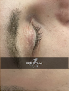 Xanthelasma is a skin condition in which flat, yellow growths develop under the skin. If it occurs on the eyelids, it is called xanthelasma palpebrarum.