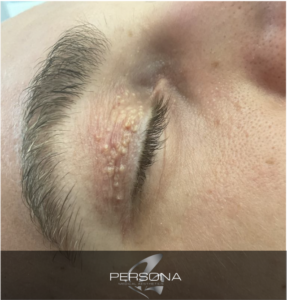 Xanthelasma is a skin condition in which flat, yellow growths develop under the skin. If it occurs on the eyelids, it is called xanthelasma palpebrarum.