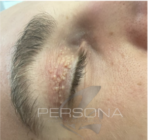 Xanthelasma is a skin condition in which flat, yellow growths develop under the skin. If it occurs on the eyelids, it is called xanthelasma palpebrarum.