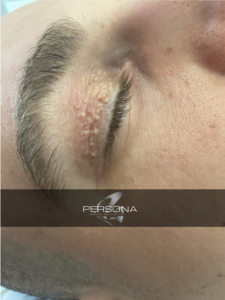 Xanthelasma is a skin condition in which flat, yellow growths develop under the skin. If it occurs on the eyelids, it is called xanthelasma palpebrarum.