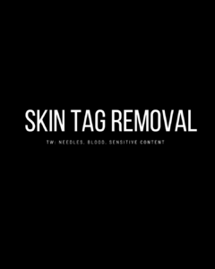 Skin tags (acrochordons) are small, noncancerous growths that tend to be the same colour as your skin. They often look like a cluster of skin tissue extending out from a tiny stem. They’re sometimes darker and may resemble a raised mole. Most skin tags are between 1-5 mm, but some can grow as large as a few centimetres. Skin tags do not affect your health. But they can be unsightly. If they are in areas like your face and neck, they can make you self-conscious. A skin tag removal procedure can help.