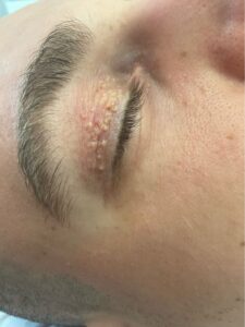 Xanthelasma is a skin condition in which flat, yellow growths develop under the skin. If it occurs on the eyelids, it is called xanthelasma palpebrarum.