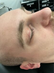 Xanthelasma is a skin condition in which flat, yellow growths develop under the skin. If it occurs on the eyelids, it is called xanthelasma palpebrarum.