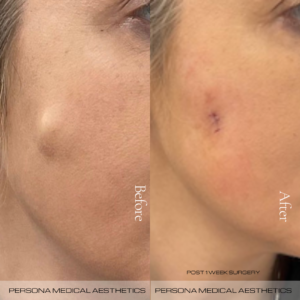 Cyst removal showing how it looks after 1 week post surgery.