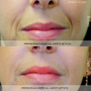 Reduction of Nasal labial folds using Dermal fillers.