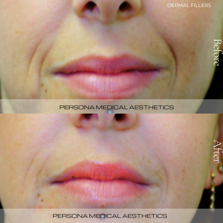 Reduction of Nasal labial folds using Dermal fillers.