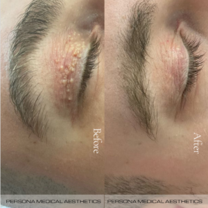 Treatment of Xanthelasma using Diathermy. Before & after image