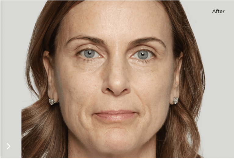 A Sculptra Persona Medical Aesthetics